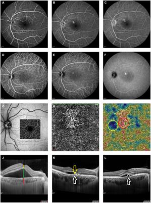 Predicting Central Serous Chorioretinopathy Recurrence Using Machine Learning